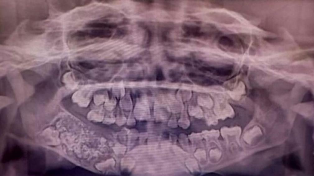 Impresionante: extrajeron 526 dientes desde la boca de un nene de 7 años