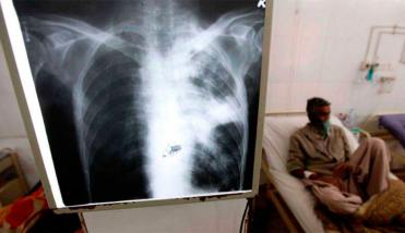 Tuberculosis: un viejo asesino invencible